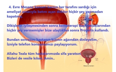 4. Evre Mesane Kanseri