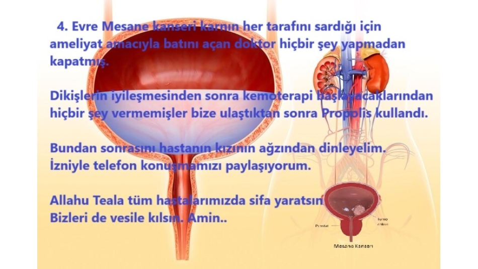 4. Evre Mesane Kanseri